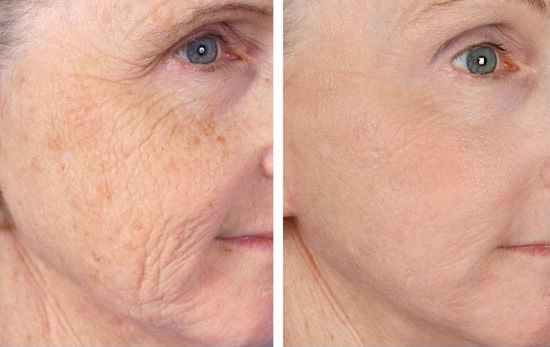 ridurile faciale înainte și după